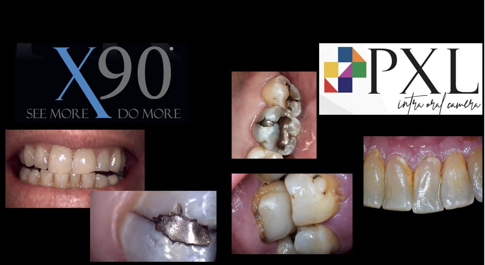 Intraoral images captured with the IRIS X90 and PXL cameras showing fractured amalgam, decay and calculus